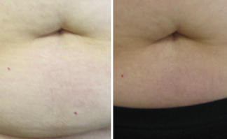 CoolSculpting treatment on abdomen