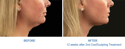 CoolSculpting submental fat before-and-after