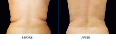 CoolSculpting back before-and-after