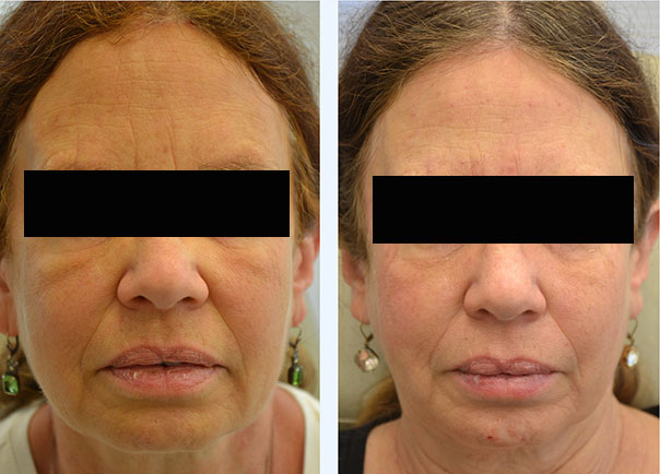 facial filler b and a