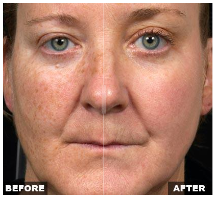 CO2 Laser Facial Rejuvenation: Fix Fine Lines, Wrinkles, Sun Damage &  Stretch Marks