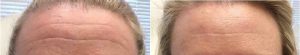 Close-up of forehead before and after microneedling.