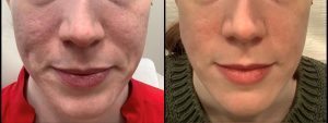 Close-up of lower two-thirds of a patient's face before and after Genius RF microneedling.