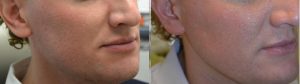 Oblique view of man's cheek and chin showing his skin before RF microneedling and after the treatment.