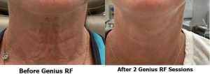 Close up of neck before and after RF microneedling.