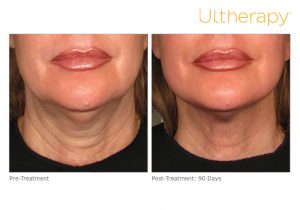 ultherapy before and after photo