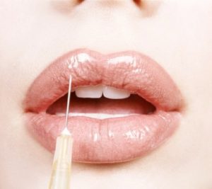 lip augmentation with fillers