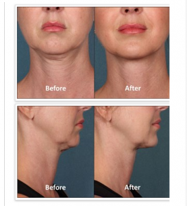 non invasive chin fat removal alexandria