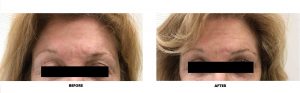 This patient had a treatment of Exilis Ultra 360 on her upper and lower eyelids to tighten and smooth the skin around her eyes. This patient had a treatment of Exilis Ultra 360 on her upper and lower eyelids to tighten and smooth the skin around her eyes.