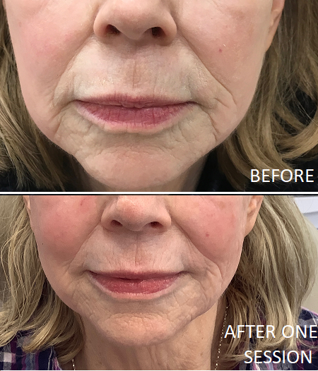 radiofrequency skin tightening near me
