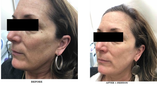 BBL/ IPL Photorejuvenation | MI Skin