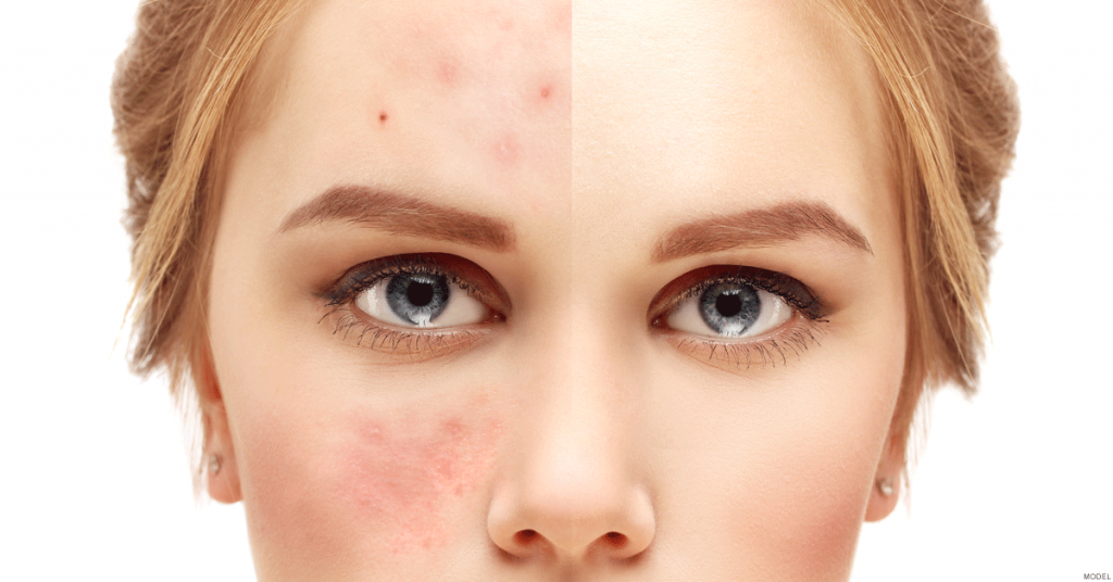 Woman displaying the difference acne vs. flawless skin can make