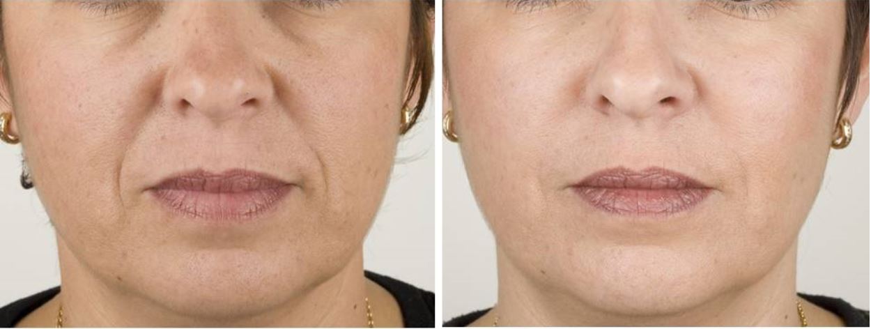 Teoxane RHA Fillers For Wrinkle Reduction In Washington DC