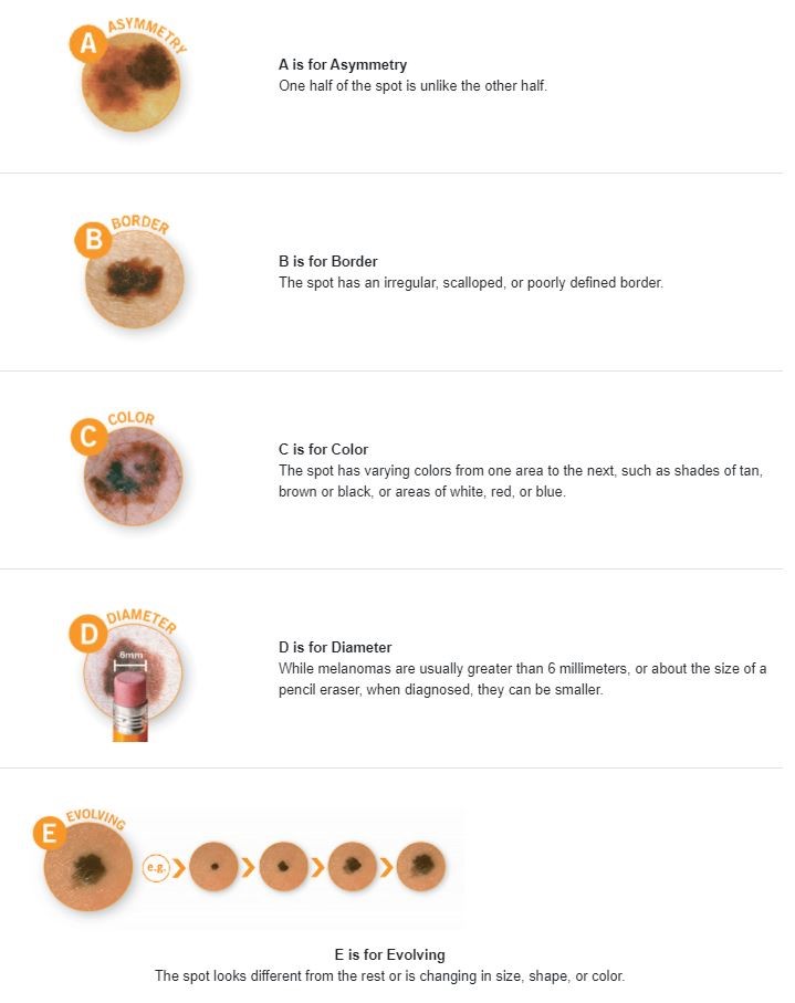 ABCs of Skin Cancer