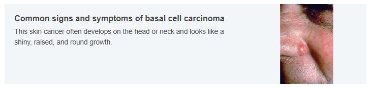 Basal Cell Carcinoma courtesy of the American Academy of Dermatology