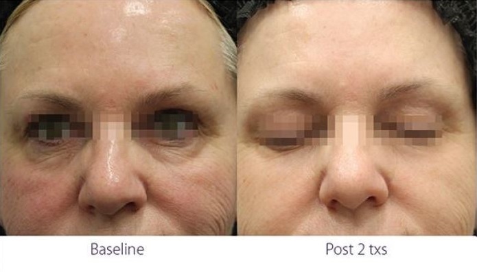 Opus Plasma RF under eye treatment before and after