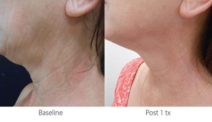 Opus Plasma RF treatment for neck before and after