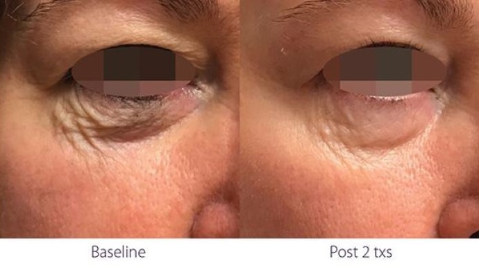 Opus Plasma RF treatment under eyes before and after