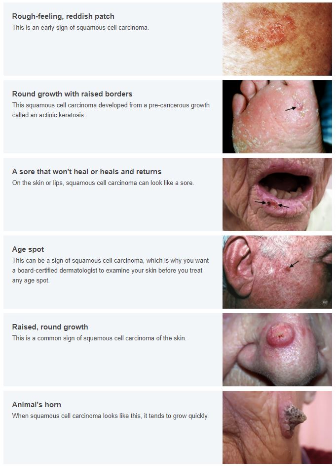 Squamous Cell Carcinoma courtesy of the American Academy of Dermatology