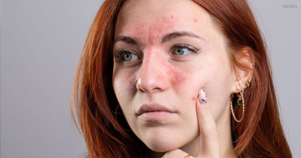 Woman with rosacea (model) holding a finger up to her face.
