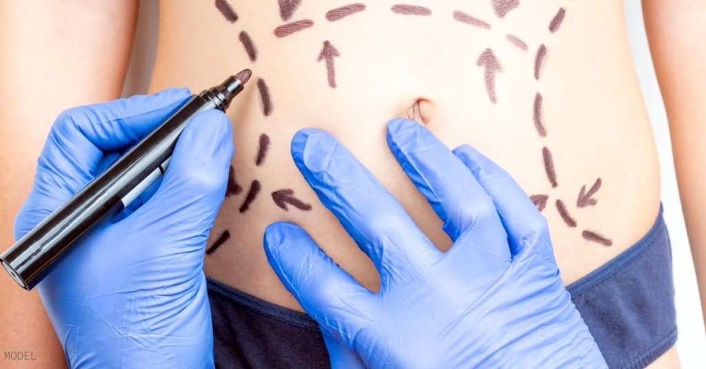 Marking likes for cool sculpting on woman's stomach
