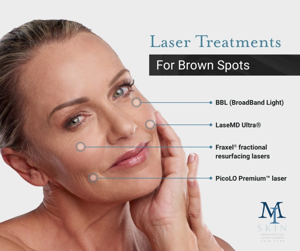Laser Treatments for Brown Spots Infographic.